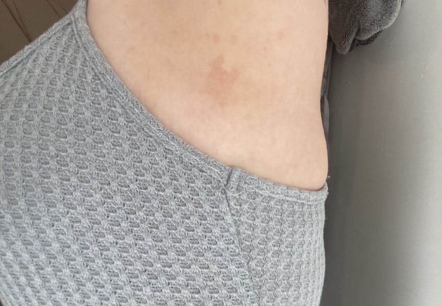 Red discoloured patch underneath armpit, pic included