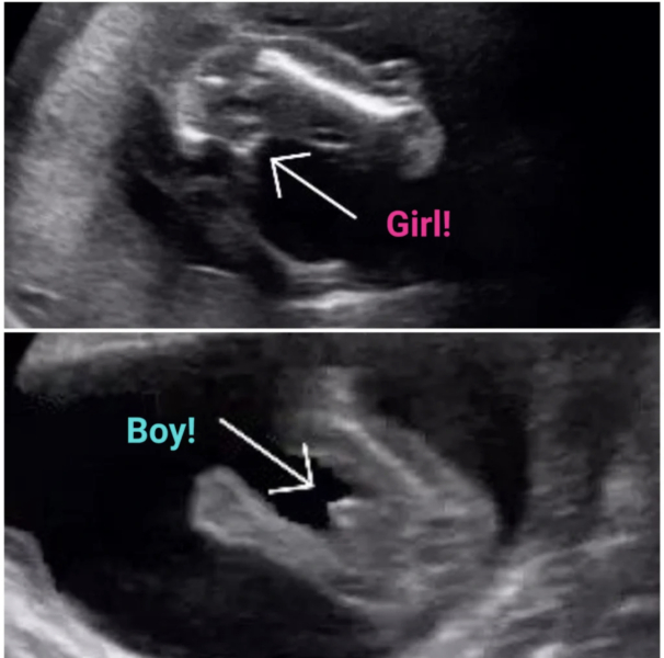 13w4d-14w gender scan, what do you think?!