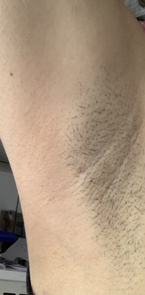 Breast lump