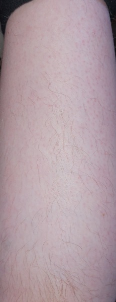 Will a lumea work (with hairy leg pics)?
