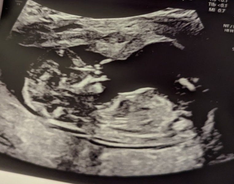 IVF warriors - journey continues