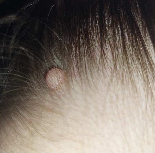 Any idea what this is on the back of my neck?
