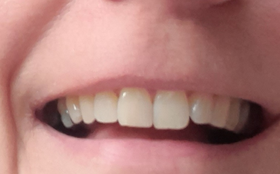 AIBU to stop invisalign on Day 2?