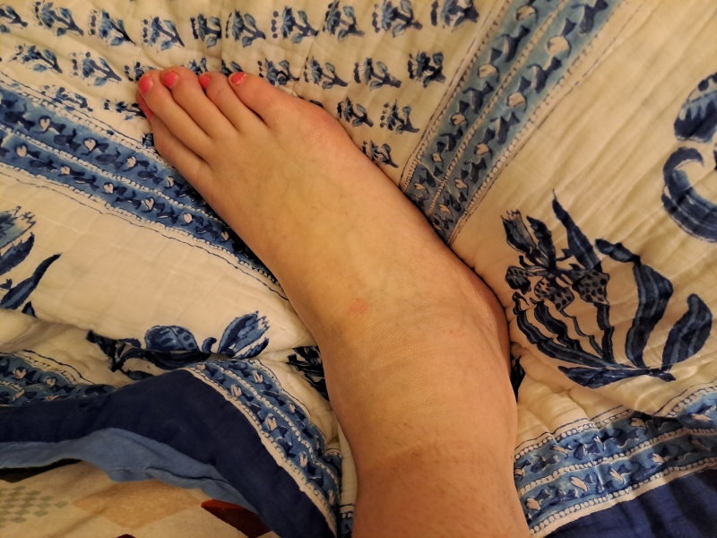 What's up with my ankle??
