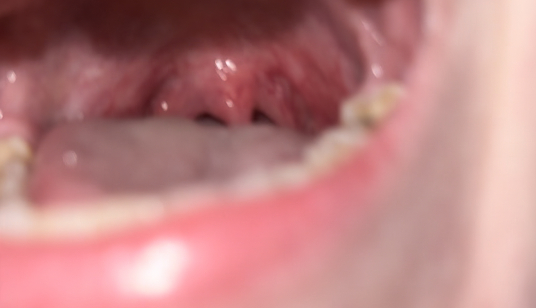 Possible tonsillitis:( 