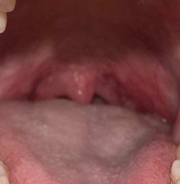 Sudden sore throat - does it need antibiotics? 