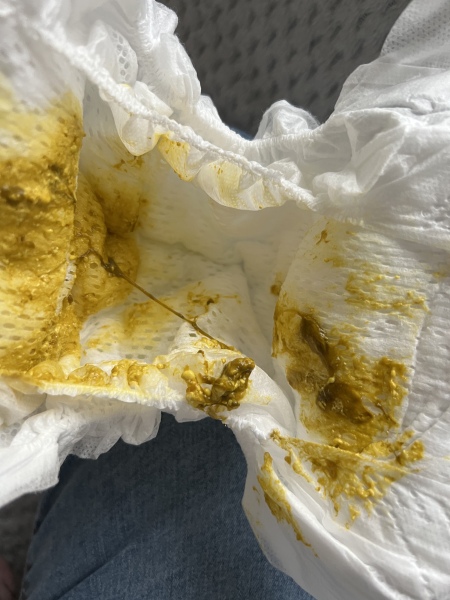 WARNING picture of mucus poo nappy, milk allergy?