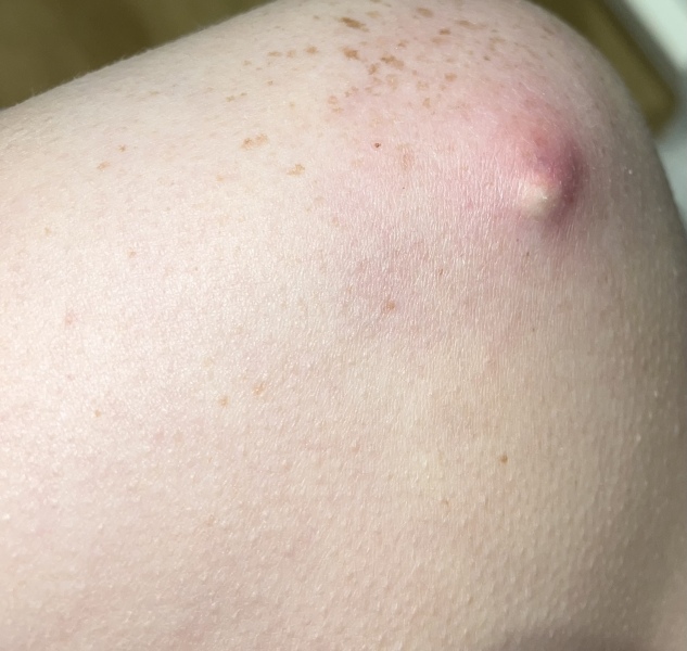 Infected Cyst (with pictures)