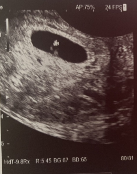 Ramzi theory - gender guesses at 6 weeks