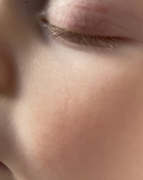 Baby scratched & scarred face