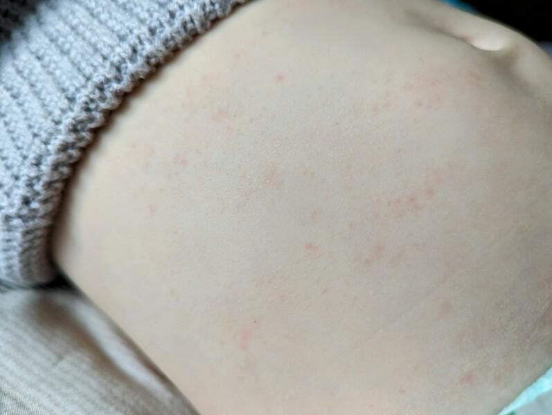 When to see GP about toddler rash? Photos 