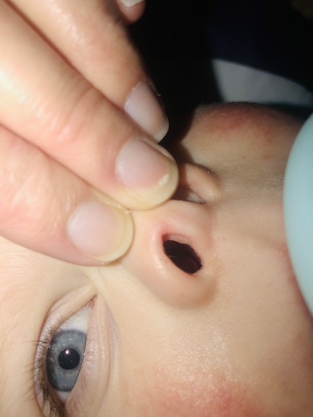 Nasal polyp?