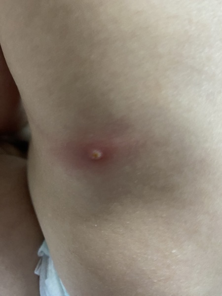 Spots on baby *pics*