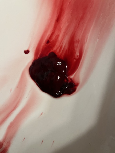 Warning photo! Is this a miscarriage or a big blood clot