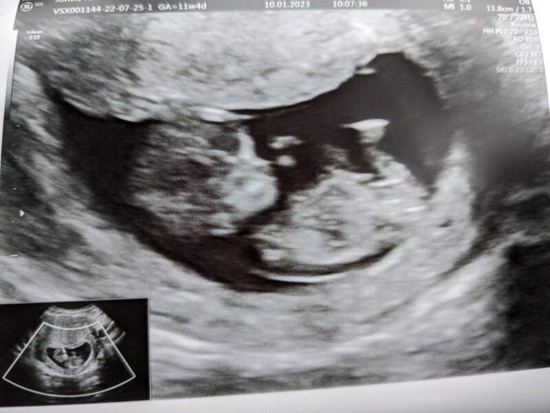 Anyone else due July after a MC? 🌈 