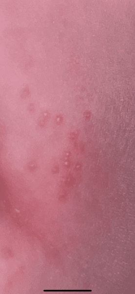 Cluster of pimples on 4mo baby’s nappy area (pic)