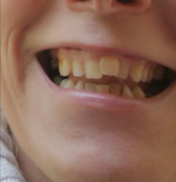 AIBU to stop invisalign on Day 2?
