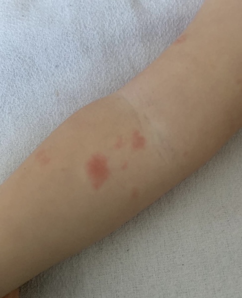 Toddlers skin