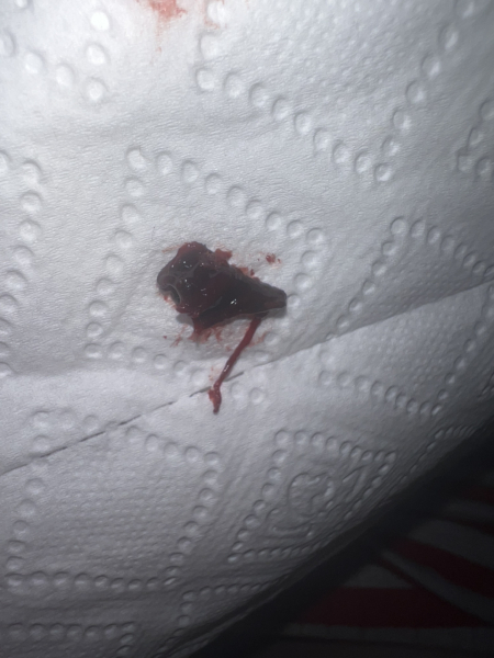 Pregnant but bleeding