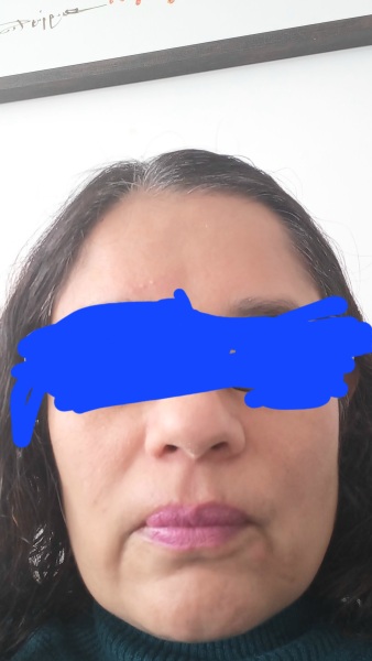 Tretinoin 