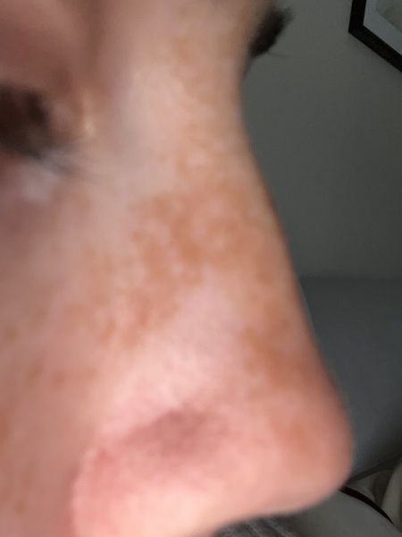 Hyper pigmentation caused by reaction to productd