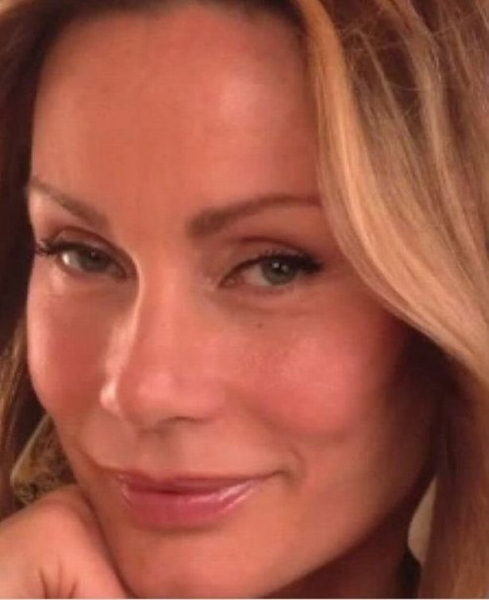 What type of cosmetic surgery is this? (pic)