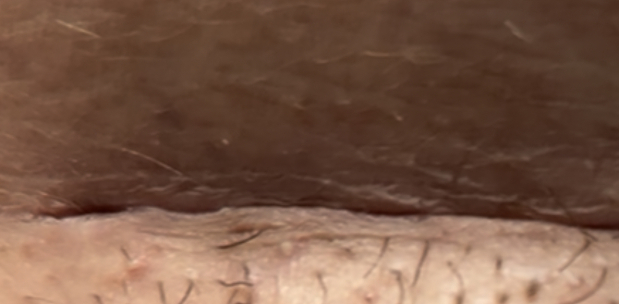 C section wound coming open? 