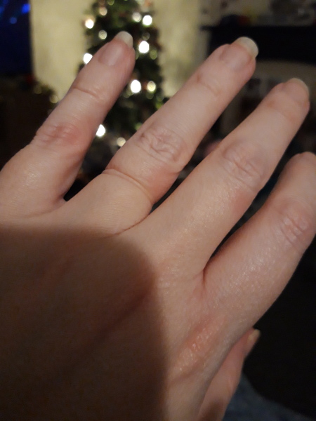 Right hand Wedding ring finger bruise 