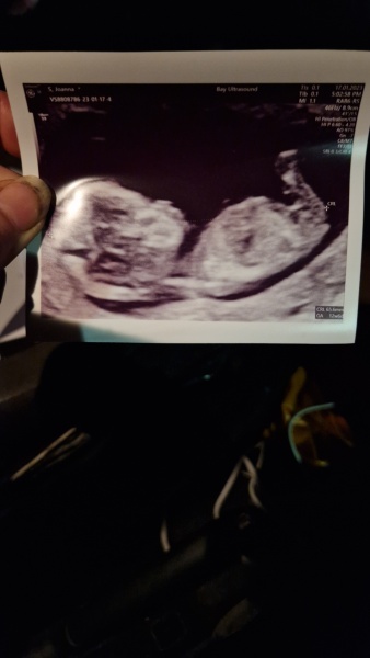 Ultrasound scan 