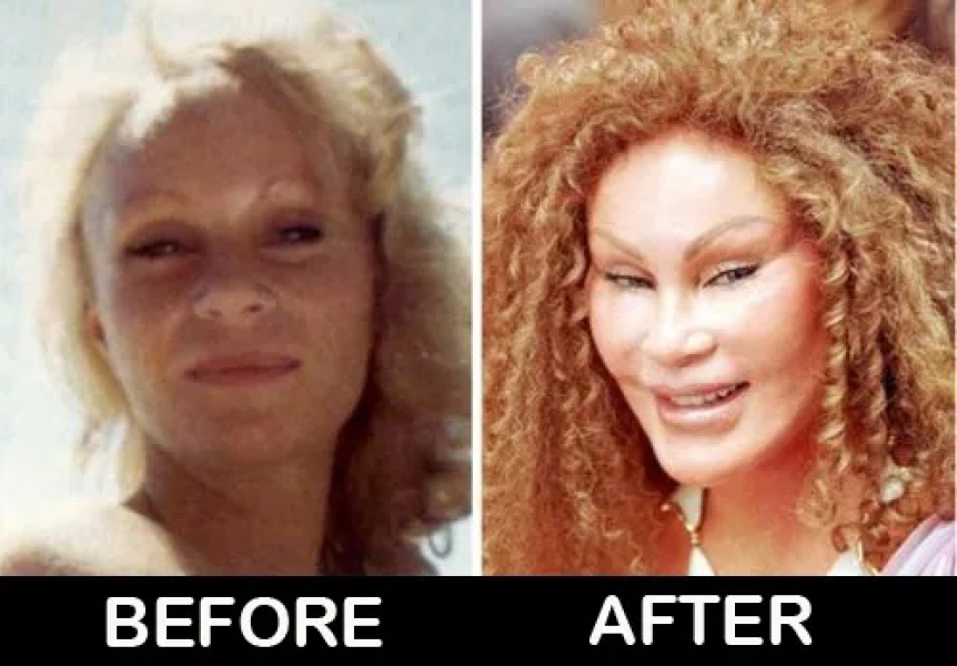 What type of cosmetic surgery is this? (pic)