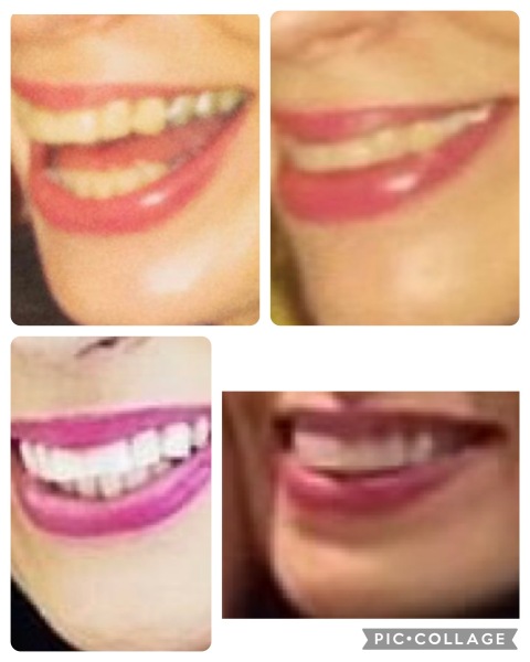 Teeth whitening 