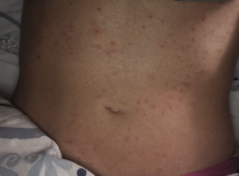 Weird rash (pic)