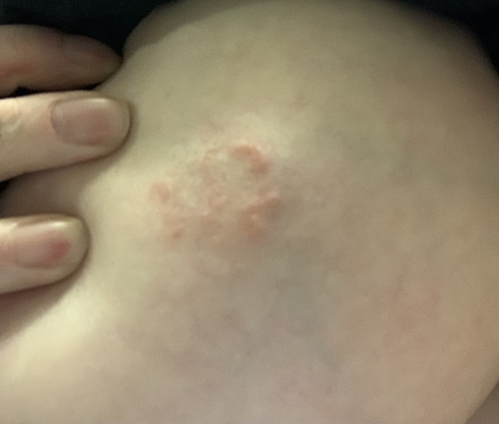 Eczema or something else? 