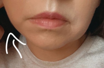 Face lift at 36? (pics included )
