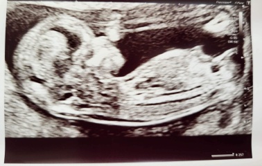 Nub theory - boy or girl? :-)