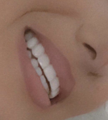 Experiences of Invisalign 