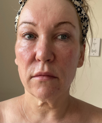What did you pay for a facelift and were you happy?