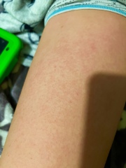 Slap cheek or scarlet fever