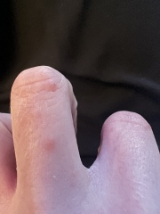 Name this rash 