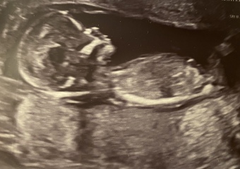 Do you think 4d scans are worth it?