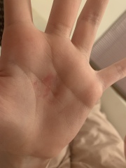 Itchy marks on palms