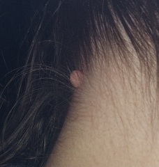 Any idea what this is on the back of my neck?