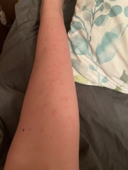 Spots/all over rash