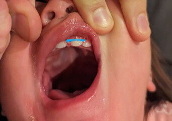 Baby split gum - Advice please (pics)
