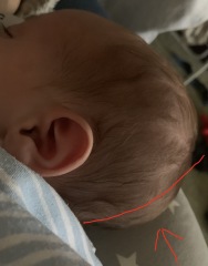 Worried sick. Is this craniosynostosis ?!