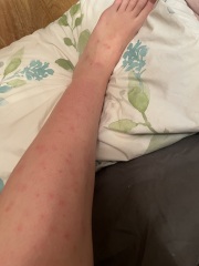 Spots/all over rash