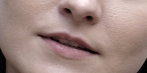 Upper lip pigmentation issue! Help!