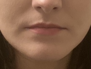 Upper lip pigmentation issue! Help!