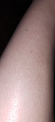 Will a lumea work (with hairy leg pics)?
