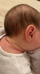 newborn acne?!
